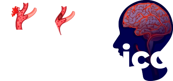 AVC Isquêmico